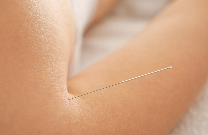 Acupuncture Chemotherapy Neurotoxicity Prevention