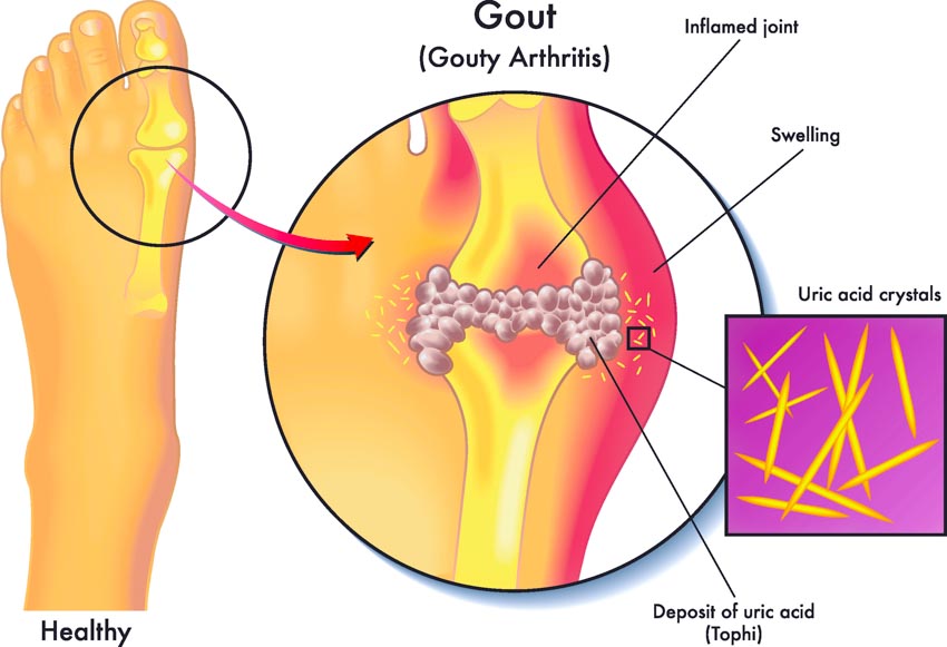 acupuncture for gout