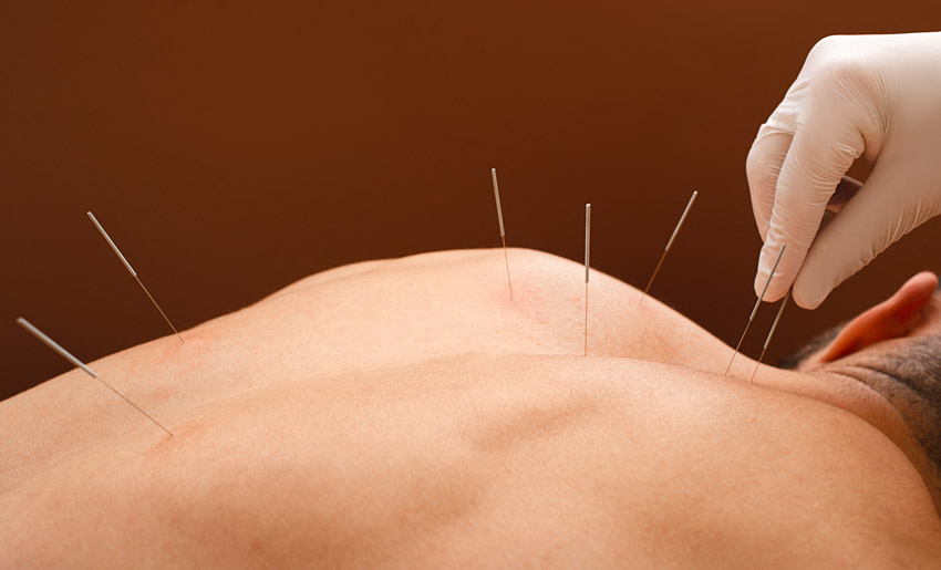 acupuncture pain relief