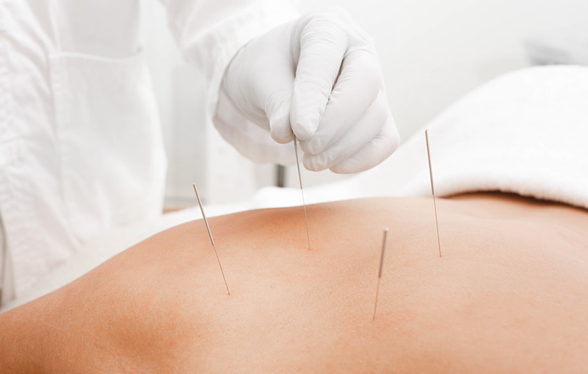 florida acupuncture mayo clinic