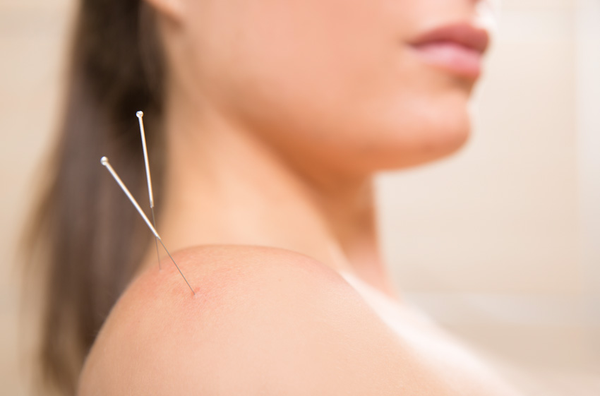 shoulder periarthritis acupuncture