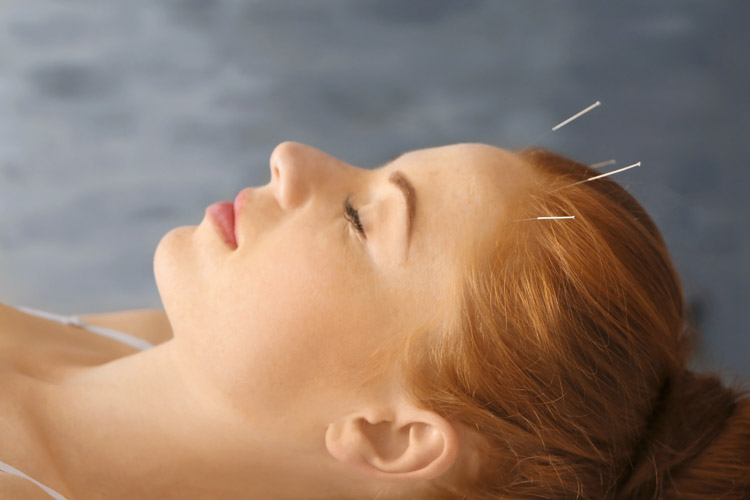 Acupuncture treatment session