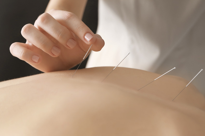Acupuncture benefits stroke patients. 
