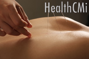 Insertion of acupuncture needles. 