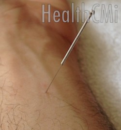 Close-up of a 1 inch acupuncture needle. 