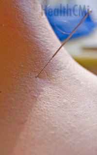 This picture shows an acupuncture needle inserted into the neck. 
