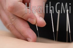 acupuncture for shingles, melbourne, fl
