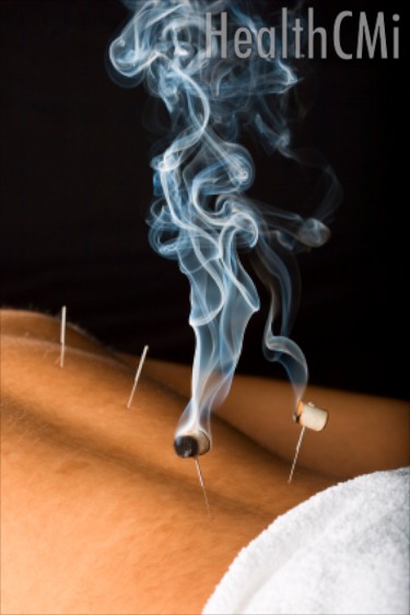 A combination of acupuncture and moxibustion was discovered more effective than an injection-supplement combination. 