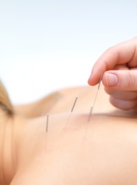 Acupuncture is effective for relieving pain. 