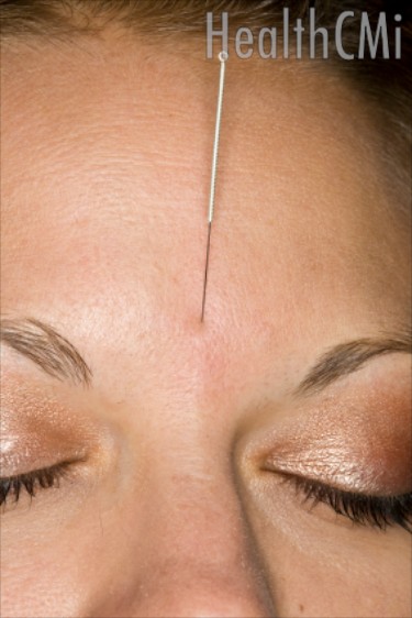 PMS is treated with several types of acupuncture and herbal medicine protocols. 