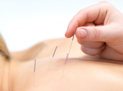 Acupuncture billing 