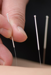 Acupuncture is depicted here. 