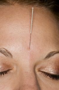Acupuncture treats acne. 