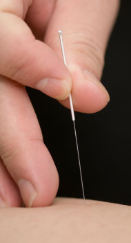 Acupuncture needling is applied in this image. 