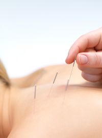 Acupuncture needle technique applied to the back is depicted. 