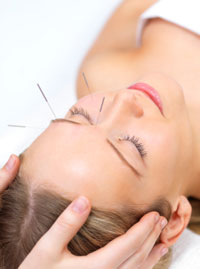 A patient receiving acupuncture is depicted here. 