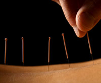 Needle stimulation transmits bioelectric energy. 