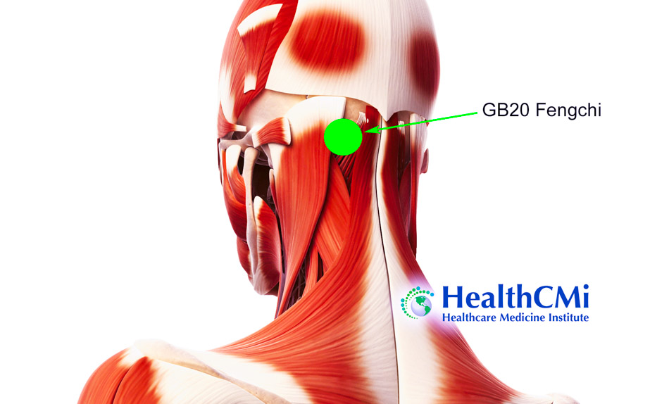 HealthCMi acupuncture GB20 CFS tcm