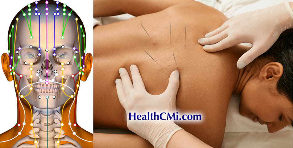 PVS acupuncture channels