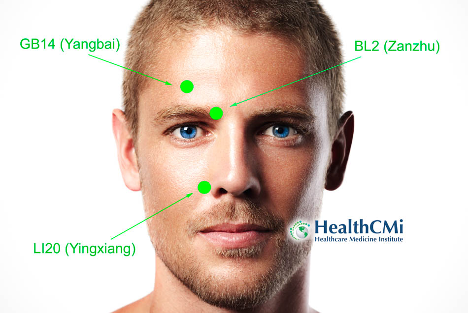 acupuncture LI20 rhinosinusitis25