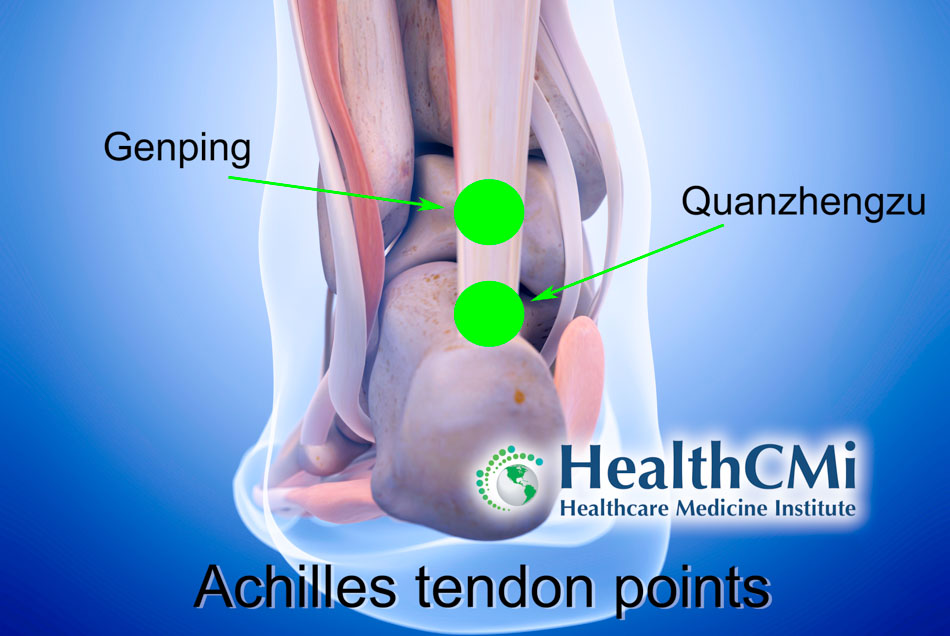 acupuncture achilles tendon25