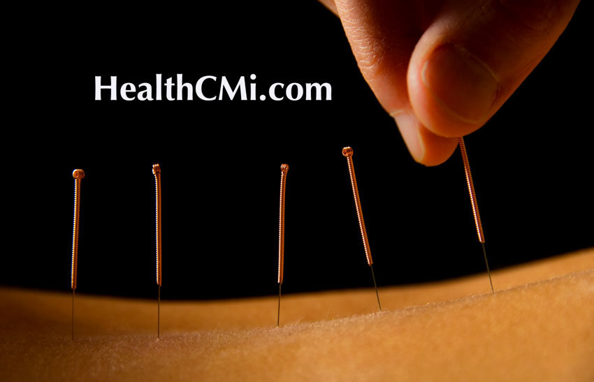 acupuncture ceu shingles herpetic