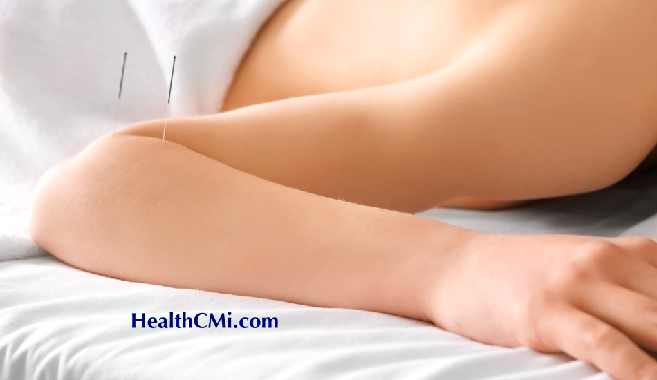 acupuncture elbow tennis 25