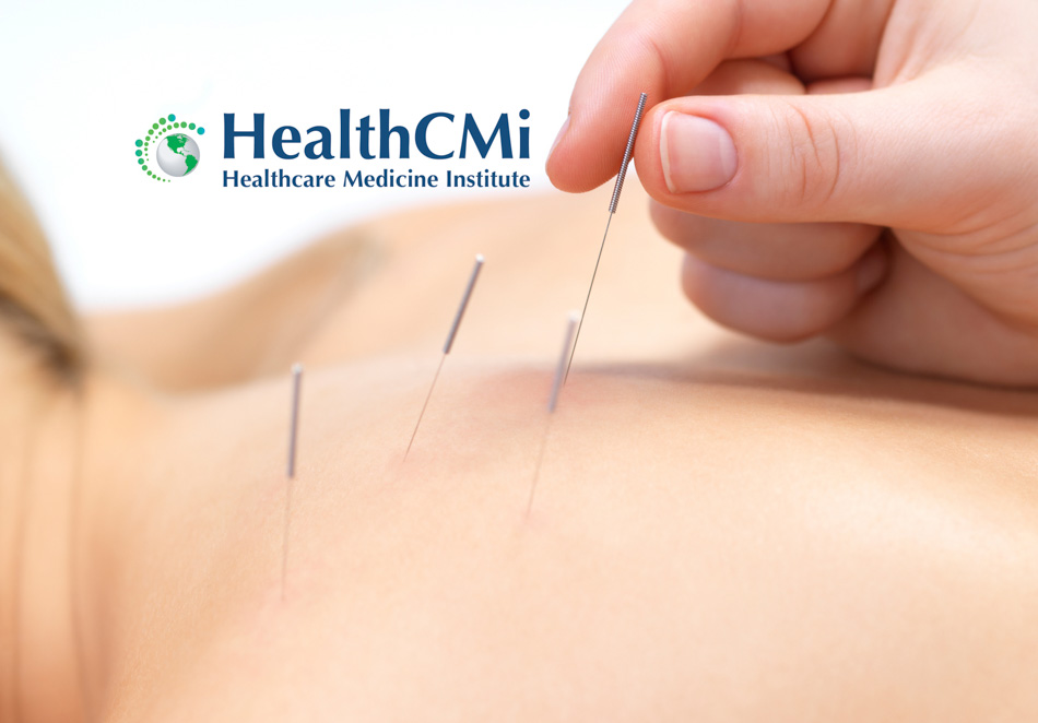 acupuncture fibromyalgia24back