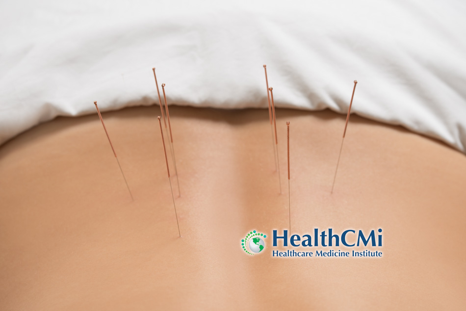 acupuncture healthcmi1172024