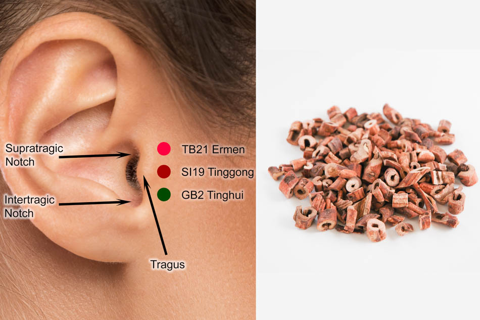acupuncture herbs tinnitus hearingLo