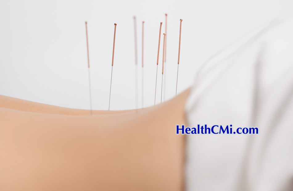 acupuncture lowback 25