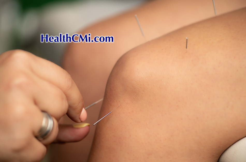 acupuncture xiyan lateral