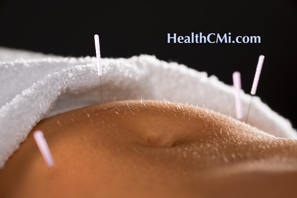 acupunctureendometriosis24fl