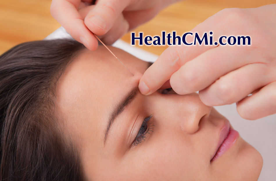 acupunctureevent72824
