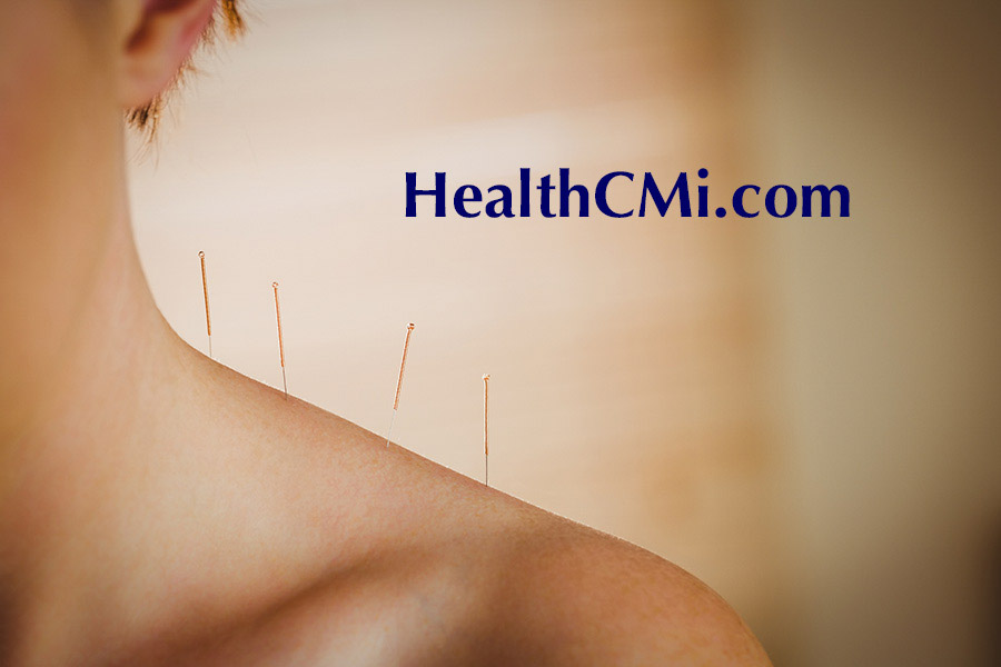 acupunctureneckcervicoGB20