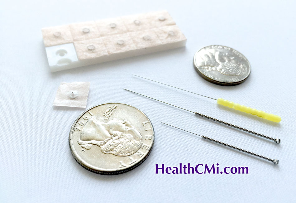 auricular acupuncture 92724