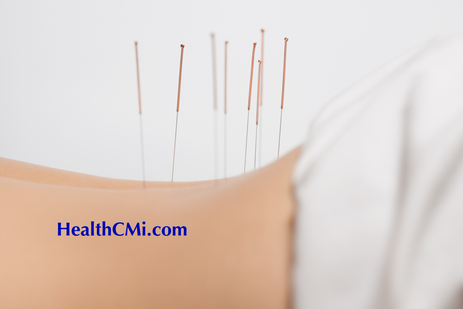 healthcmiAlbertaacupuncture24