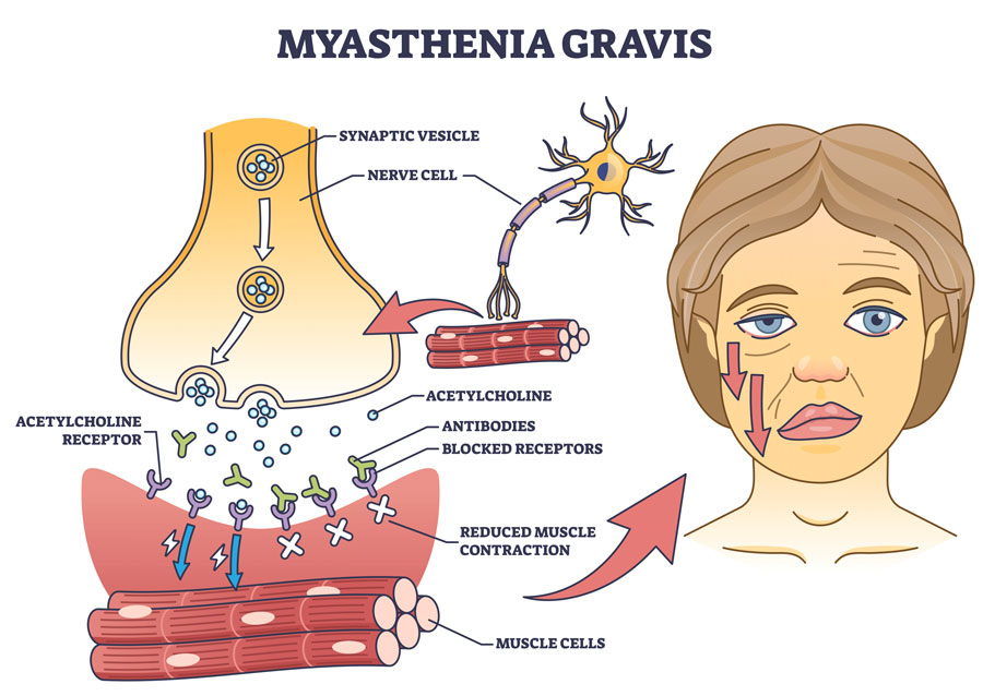 myasthenia gravis healthcmiceus