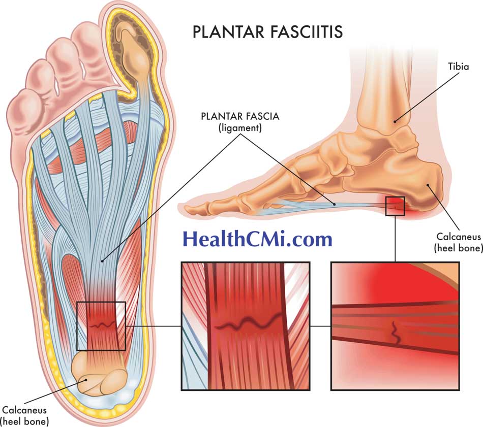 plantarfasciitisacupuncture25825