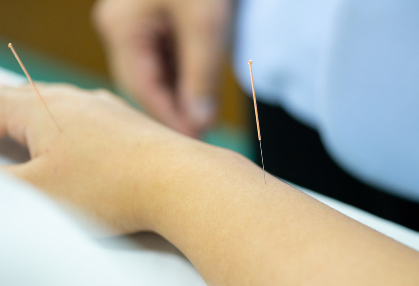 Acupuncture Chemotherapy