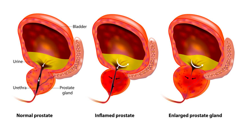 Prostatita uprozhneniya