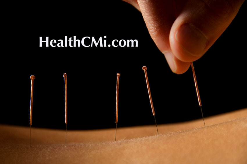 acupuncture spinal isci