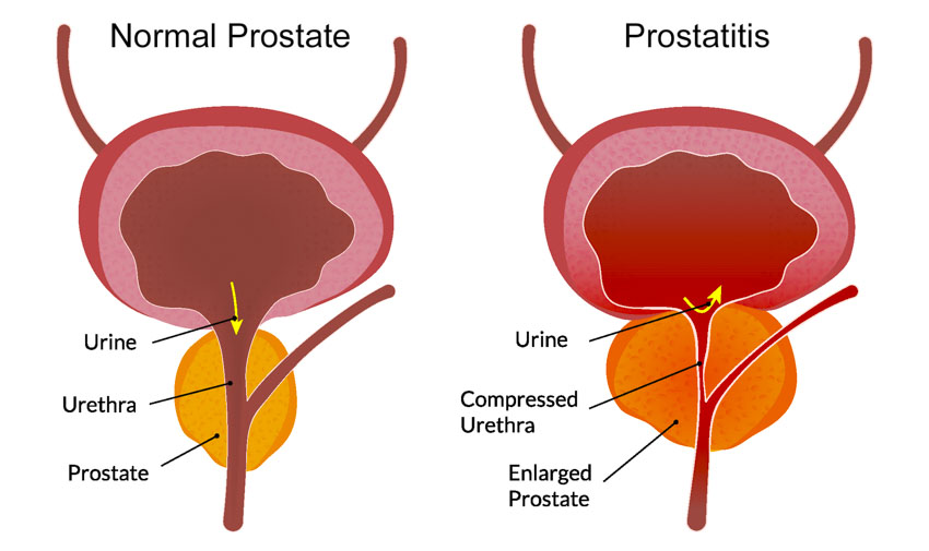 durere în prostatita la bărbați cum să se trateze