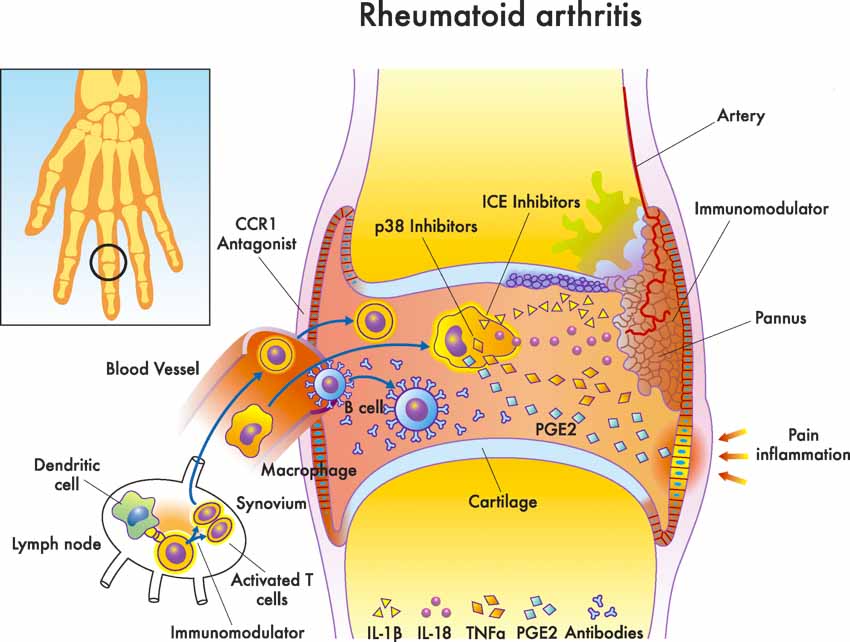 La Acupuntura alivia el dolor e inflamación en la artritis reumatoide