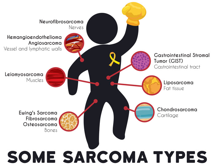 sarcoma oncology