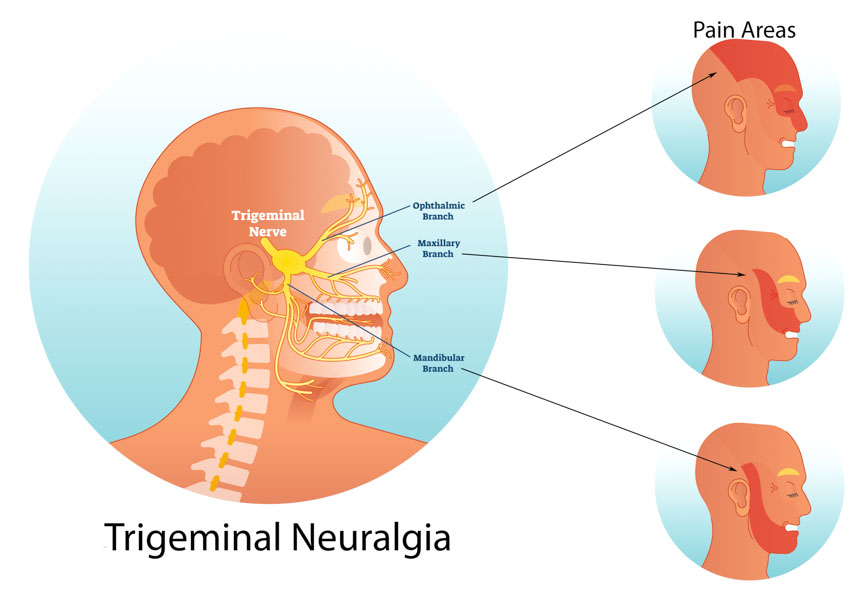 trigeminal neuralgia