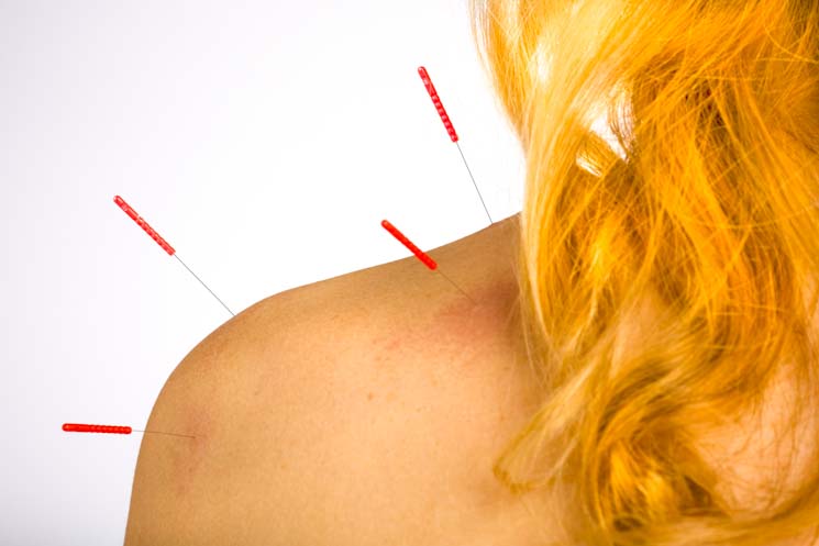 Is Acupuncture Good for Trapped Nerves 