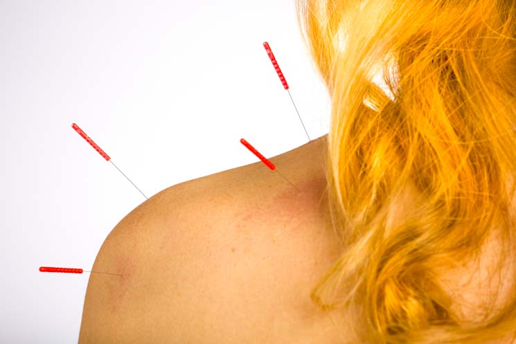 Is Acupuncture Good for Trapped Nerves