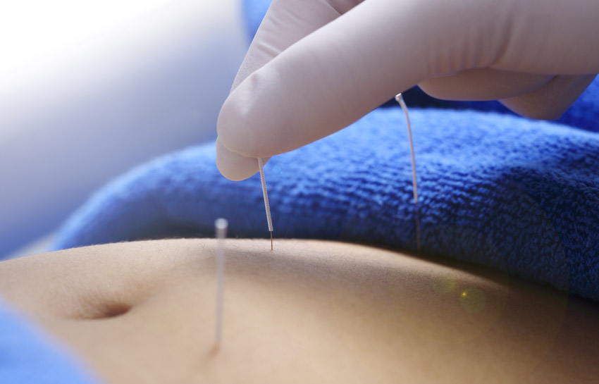 PCOS Acupuncture