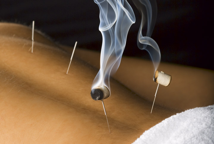 Acupuncture with lumbar area moxibustion is demonstrated on a patient. 